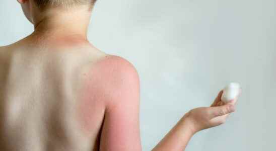 Sunburn in children solutions Biafine what age