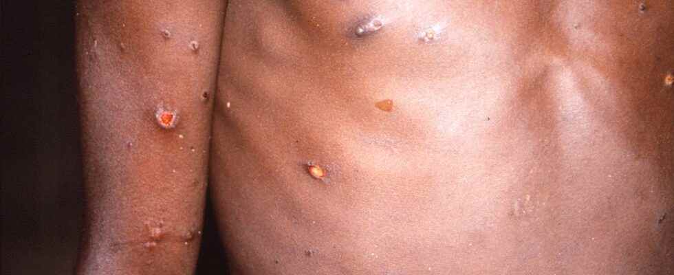 Triple the number of monkey pox in Europe