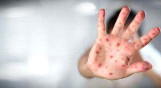 What are the symptoms of Monkey Pox Does Monkey Pox