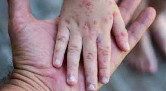 What are the symptoms of Monkeypox virus does it kill
