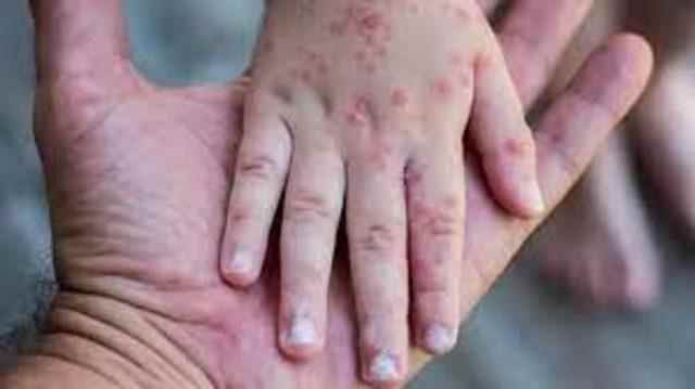 What are the symptoms of Monkeypox virus does it kill
