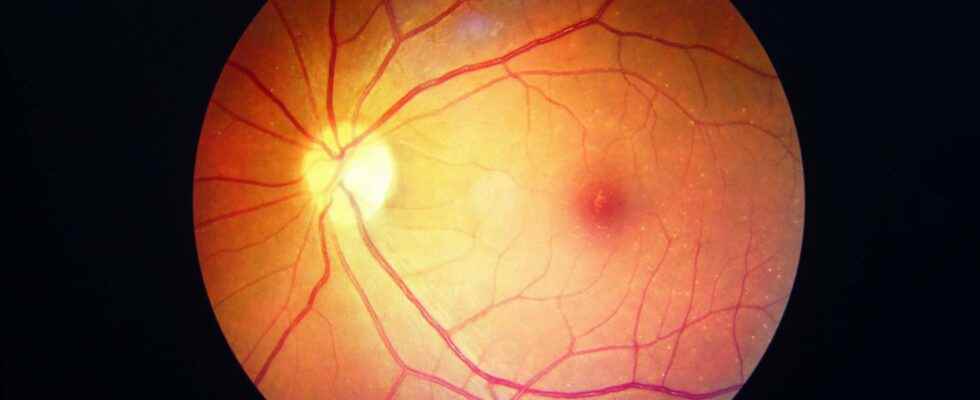 Diabetic retinopathy what is it