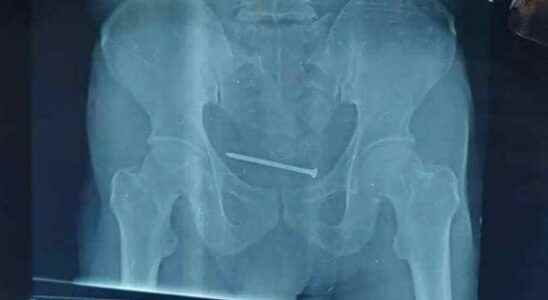 Doctors are stunned 10 cm rusty nail came out