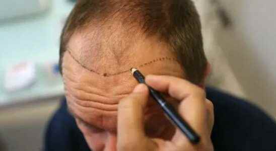 How to do hair transplantation You need to know these