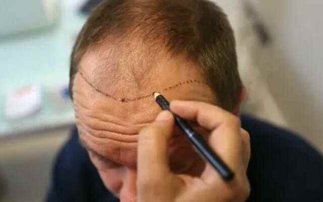 How to do hair transplantation You need to know these