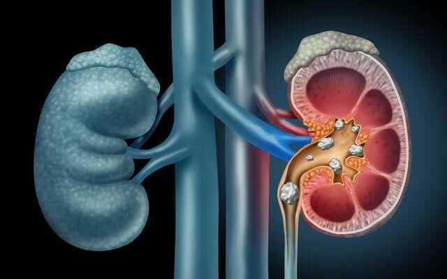 Solve the kidney stone problem with the recipe of Ibn