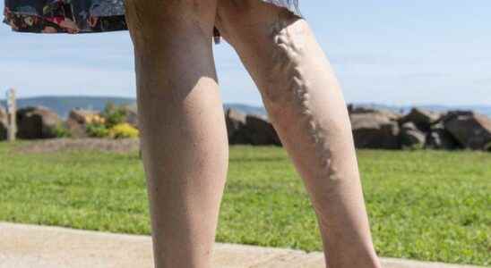Things to consider to avoid varicose veins