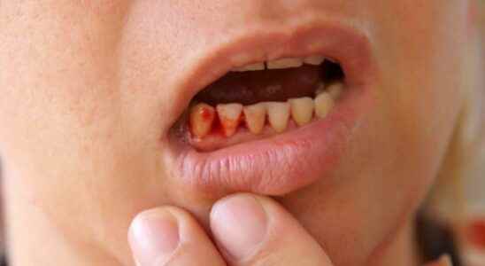 Your smile warns of diseases If it looks like this…