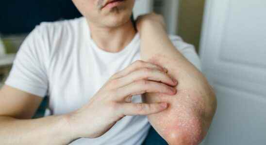 Atopic eczema one in three patients finds no treatment that