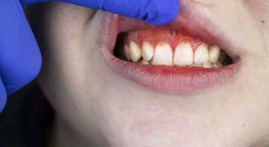 Do not underestimate dental health It causes such a disease