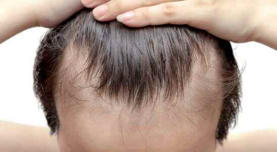 It accelerates hair loss causes baldness irritates the scalp Definitely