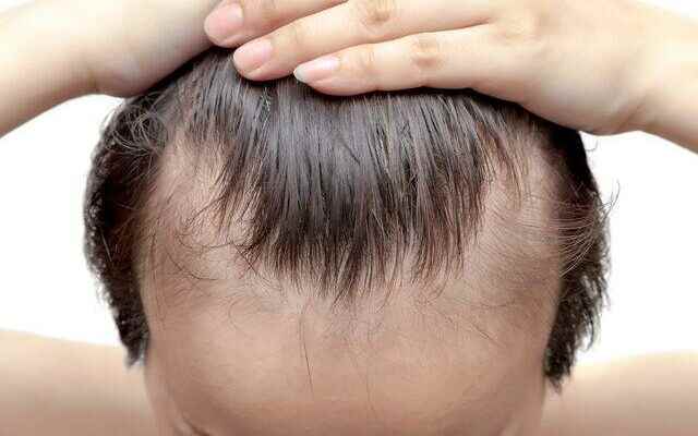 It accelerates hair loss causes baldness irritates the scalp Definitely
