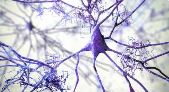 Alzheimers disease what if it was ultimately an autoimmune disease