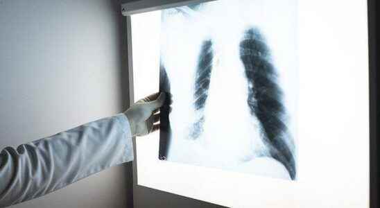 Annoying statement from the World Health Organization Tuberculosis cases on