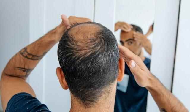 Bald men beware Your risk of heart disease is higher