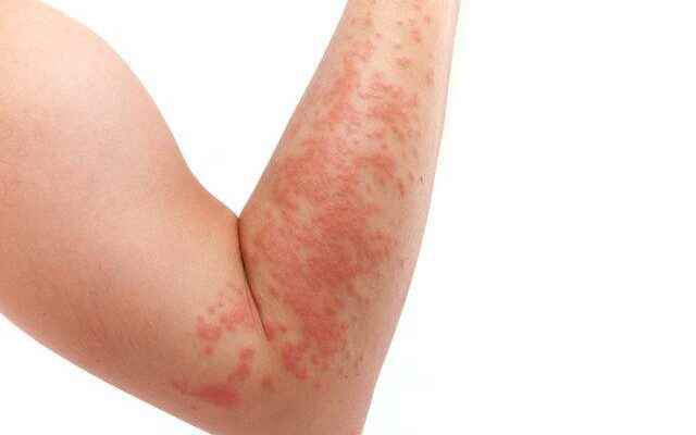 Eczema may not be as bad as you think May
