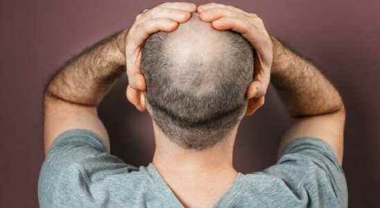 It works one hundred percent Baldness becomes history Cure found