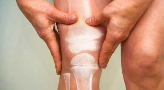 Osteoarthritis low weight gain increases the risk of knee prosthesis