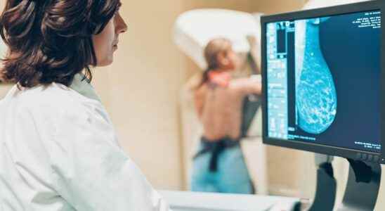 Breast cancer towards personalized screening