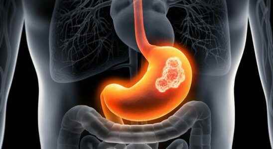 Dont overlook it Critical symptom of stomach cancer 80 of