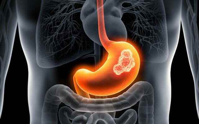 Dont overlook it Critical symptom of stomach cancer 80 of