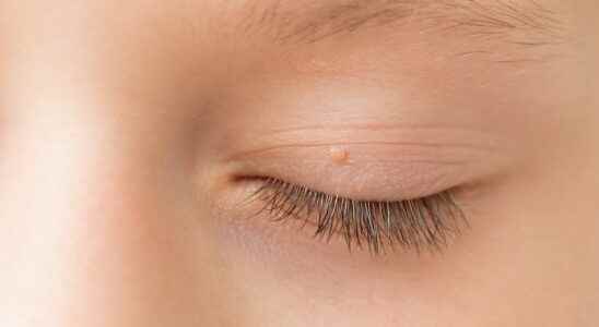 Filiform wart eyelid nose cause treatment