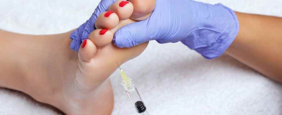 Foot botox the trend that has been rising since the