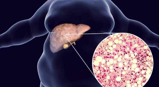 NASH fatty liver symptoms what is soda disease