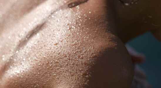 Sweat allergy signs can it be treated
