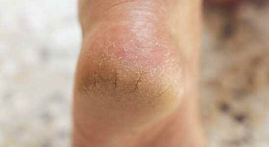 The natural way to heal dry and cracked heels The