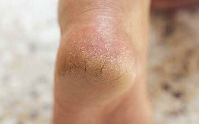 The natural way to heal dry and cracked heels The