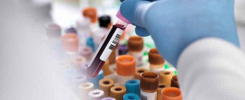 This new blood test can screen for liver cancer