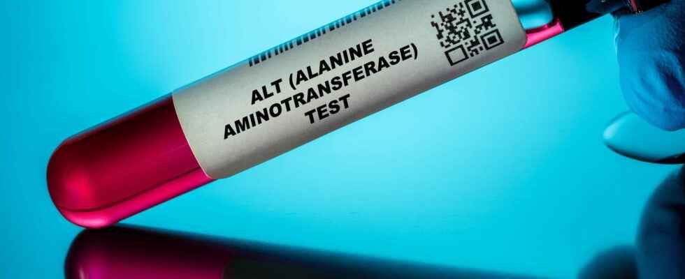 Transaminases AST ALT SGPT SGOT elevated symptoms