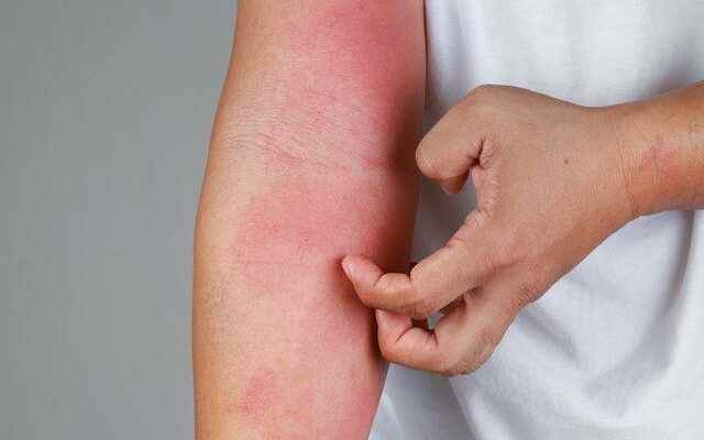Triggers skin diseases Health News