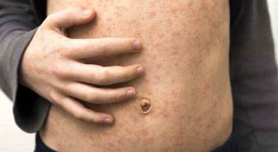 Watch out for measles symptoms Millions of children could die