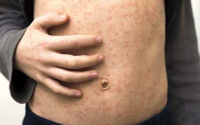 Watch out for measles symptoms Millions of children could die