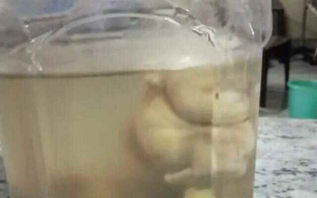 What came out of the newborn babys stomach was astonishing