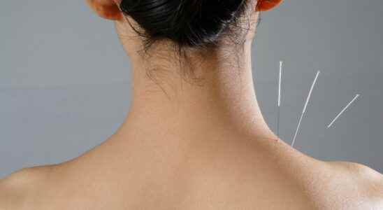 Acupuncture no it is not effective even in pregnant women