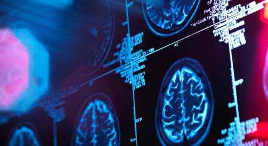 Against Alzheimers Lecanemab confirms its promising results