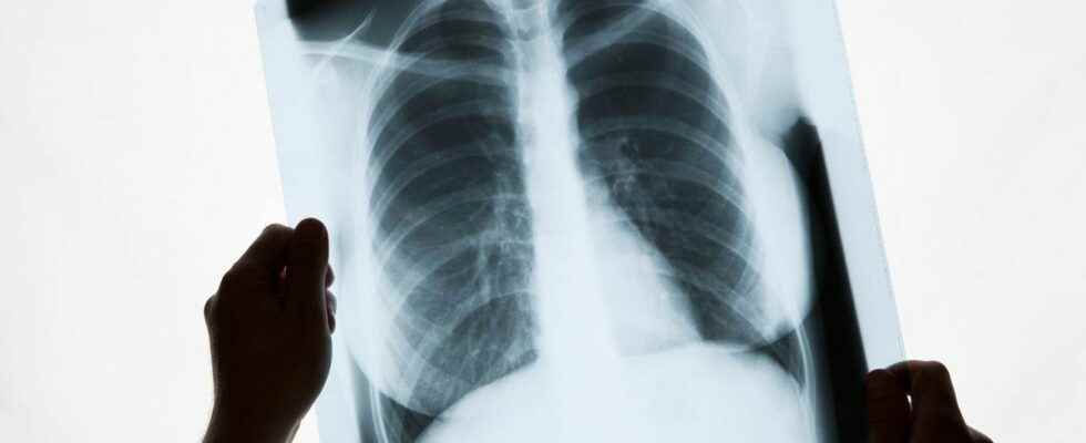 Artificial intelligence predicts cardiovascular risk using a simple chest X ray