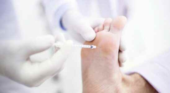 Botox of the feet a phenomenon that is happening in