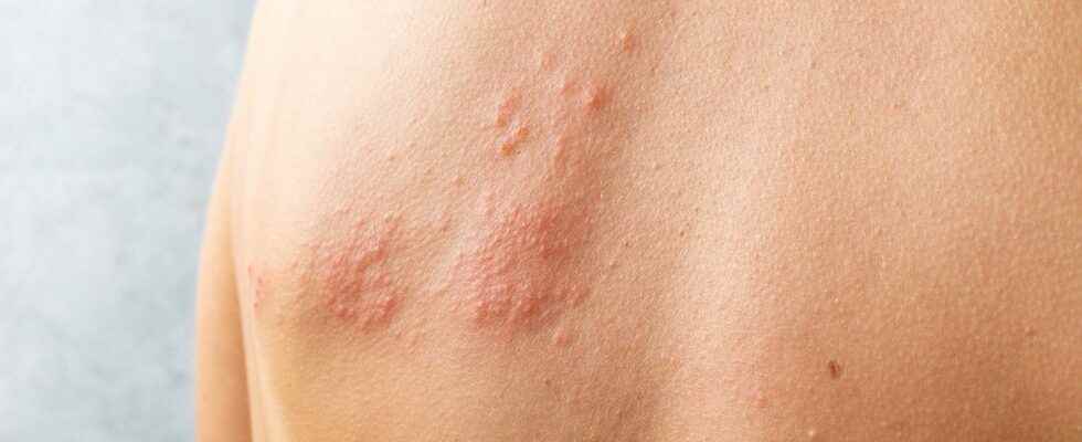 Does the varicella zoster virus increase the risk of cardiovascular problems