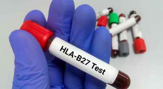 HLA B27 antigen transmission when to look for it