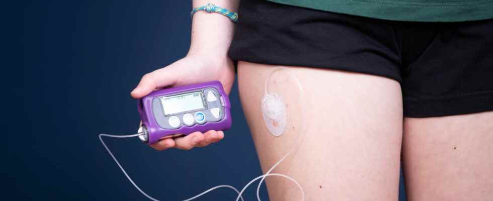 Insulin pump for whom how does it work
