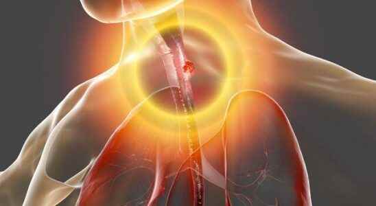 It is the first sign of esophageal cancer See your