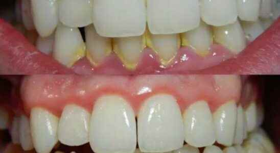 Its in every home Solutions to eliminate dental tartar and
