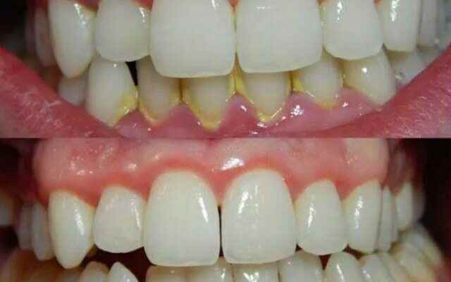 Its in every home Solutions to eliminate dental tartar and