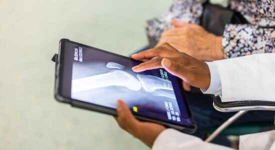 Knee osteoarthritis an AI enables ultra early diagnosis