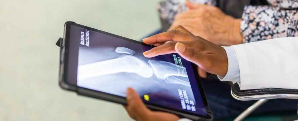 Knee osteoarthritis an AI enables ultra early diagnosis