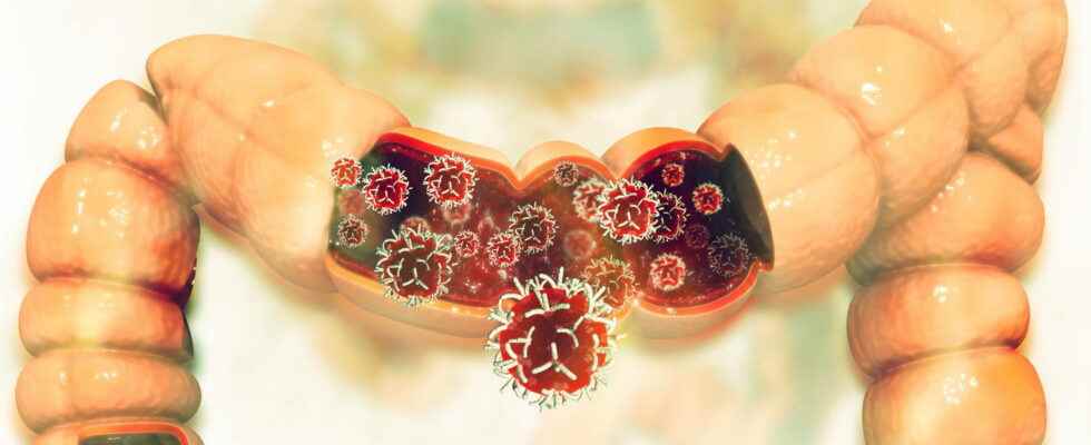 Lieberkuhnian adenocarcinoma symptoms prognosis